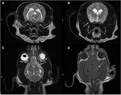 Case Report: Mineralized Pulmonary Artery Thrombi in Two Dogs Treated for Meningoencephalitis of Unknown Origin